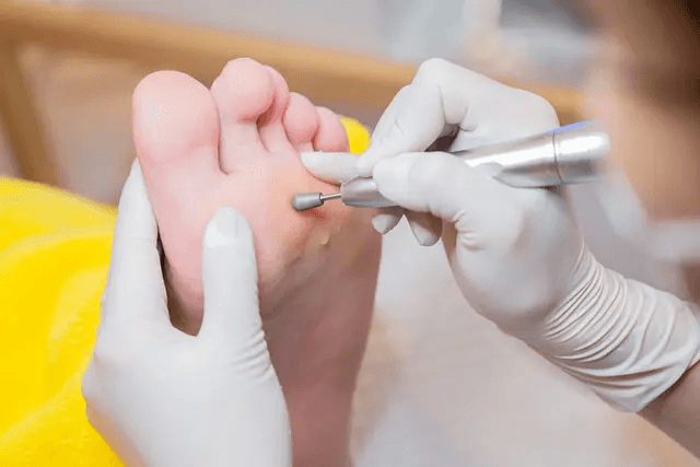 うおのめ・たこ足裏ケア